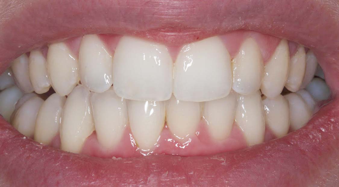 Braces then whitening – after